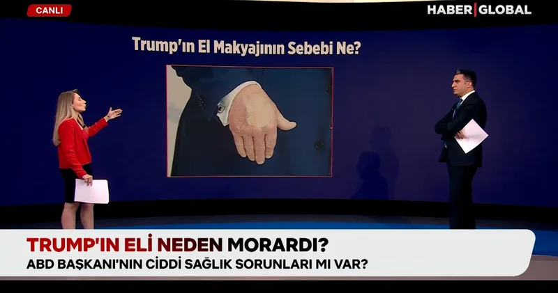 Trump ın eli neden morardı?