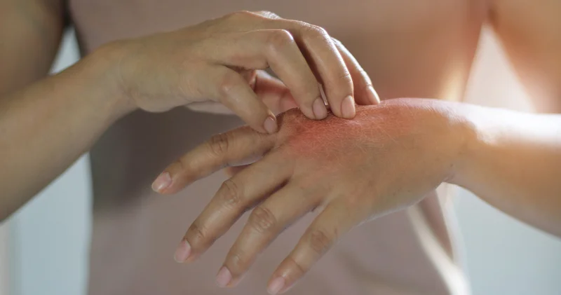 6 dakikalık temas, günlerce kaşıntı! Sivrisineklerle mücadelede doğal ve etkili çözüm yöntemleri