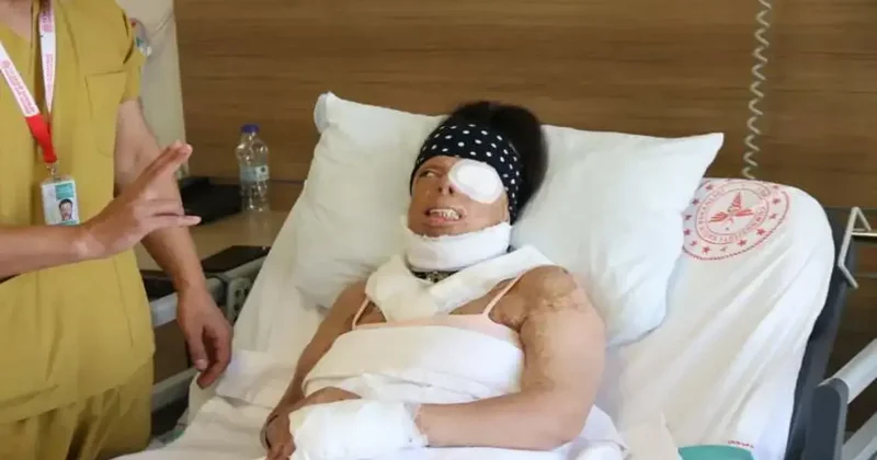 Uykusundayken eski sevgilisi yüzüne kezzap attı! Genç kadının hayatı karardı