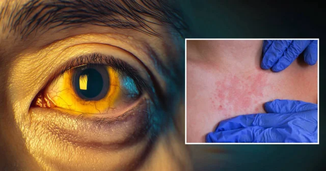 Bakan Memişoğlu ndan akut hepatit vurgusu! Türkiye’nin bu hastalıktan kurtulması gerekiyor: İşte hepatitin en yaygın belirtileri Sağlık Haberleri