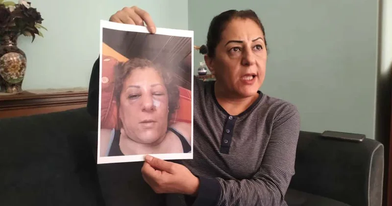 Bu da hayvan düşmanlığı şiddeti: Kedi beslediği için bir kadının burnunu kırdılar