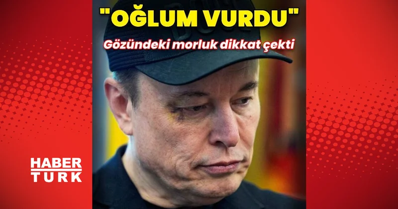 Elon Musk ın gözündeki morluk dikkat çekti Dış Haberler